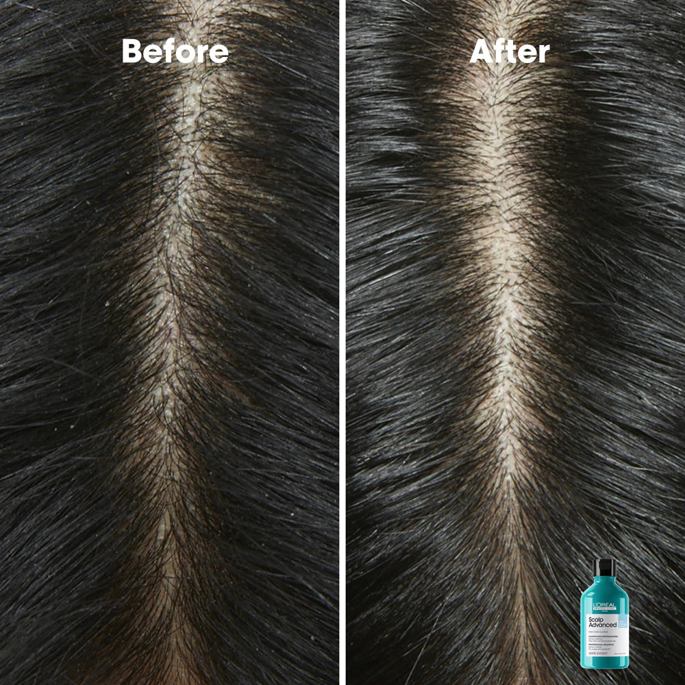 Scalp Advanced Anti-Dandruff Dermo-Clarifier Shampoo